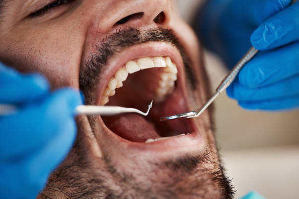 Best Knocked-Out Tooth (Avulsed Tooth) Treatment in Manchester Center, VT
